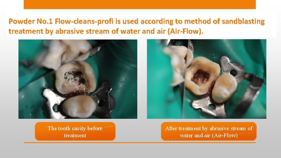 Powder No. 1 Flow-cleans-profi is used according to method of sandblasting treatment by abrasive