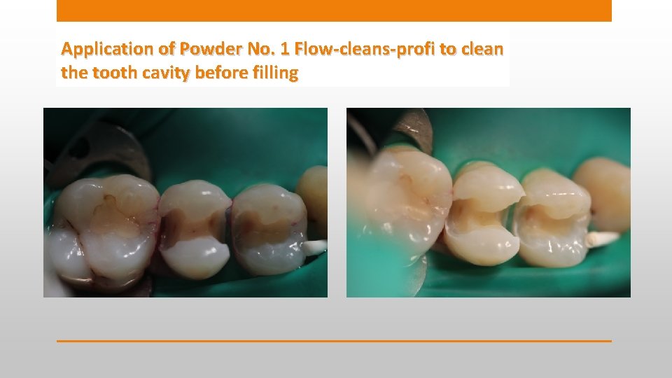 Application of Powder No. 1 Flow-cleans-profi to clean the tooth cavity before filling 