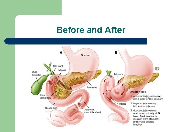 Before and After 