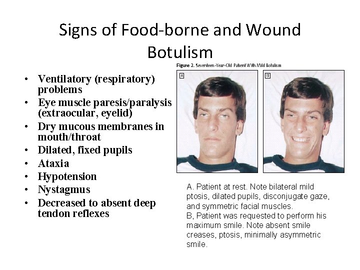 Signs of Food-borne and Wound Botulism • Ventilatory (respiratory) problems • Eye muscle paresis/paralysis