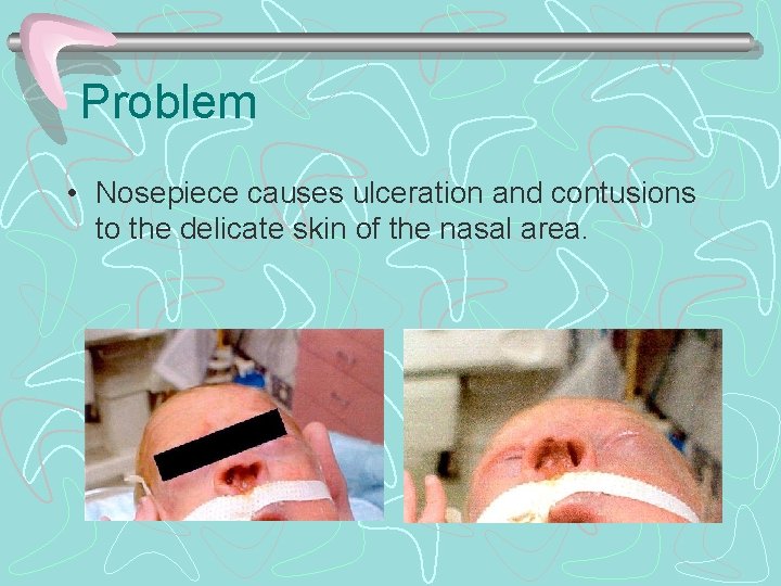 Problem • Nosepiece causes ulceration and contusions to the delicate skin of the nasal
