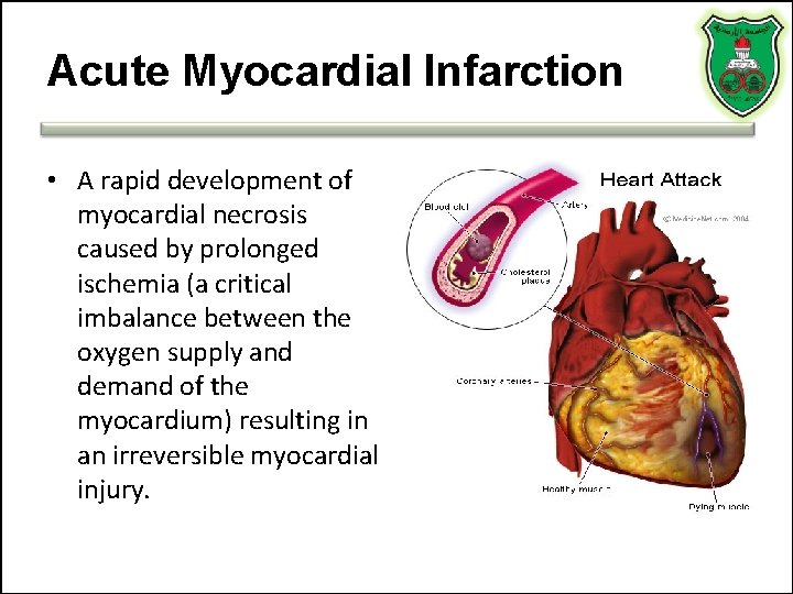 Acute Myocardial Infarction • A rapid development of myocardial necrosis caused by prolonged ischemia Acute Myocardial Infarction • A rapid development of myocardial necrosis caused by prolonged ischemia