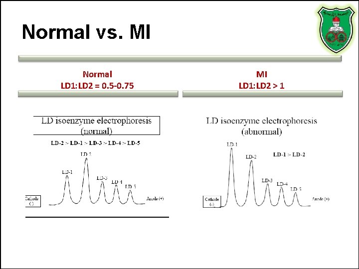 Normal vs. MI Normal LD 1: LD 2 = 0. 5 -0. 75 MI Normal vs. MI Normal LD 1: LD 2 = 0. 5 -0. 75 MI