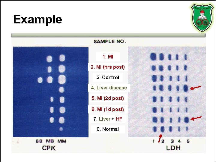 Example 1. MI 2. MI (hrs post) 3. Control 4. Liver disease 5. MI Example 1. MI 2. MI (hrs post) 3. Control 4. Liver disease 5. MI