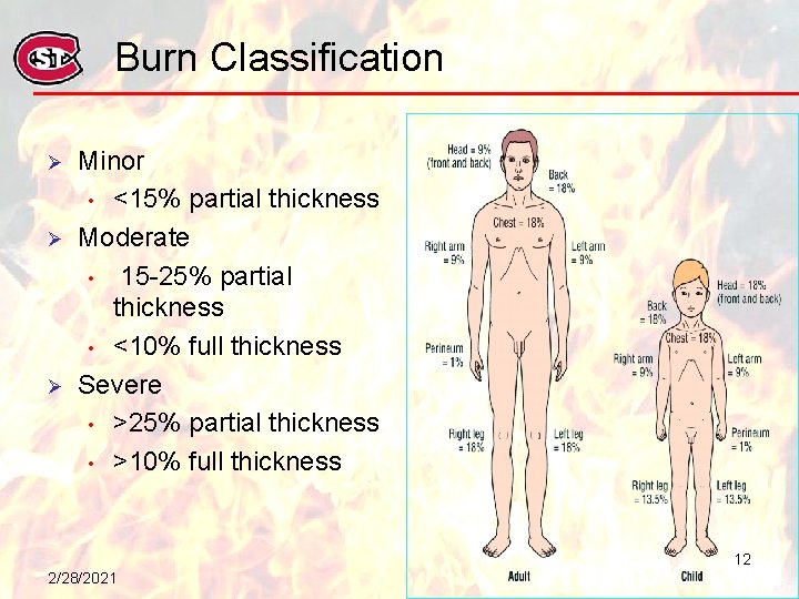 Burn Classification Ø Ø Ø Minor • <15% partial thickness Moderate • 15 -25%