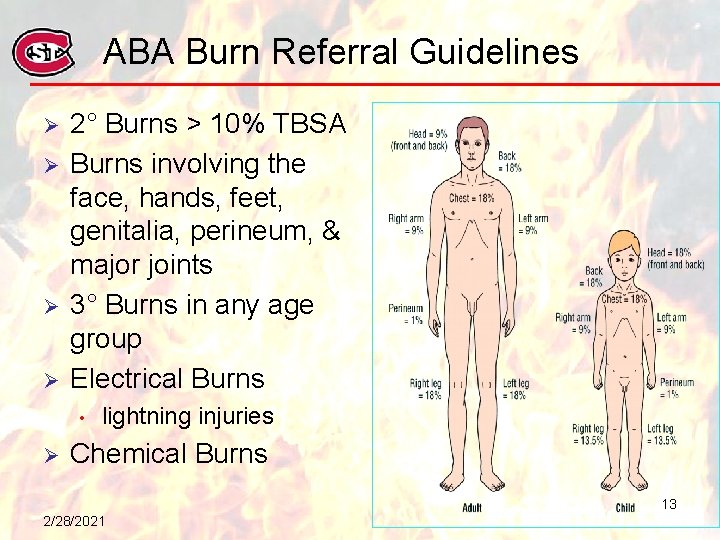 ABA Burn Referral Guidelines Ø Ø 2° Burns > 10% TBSA Burns involving the