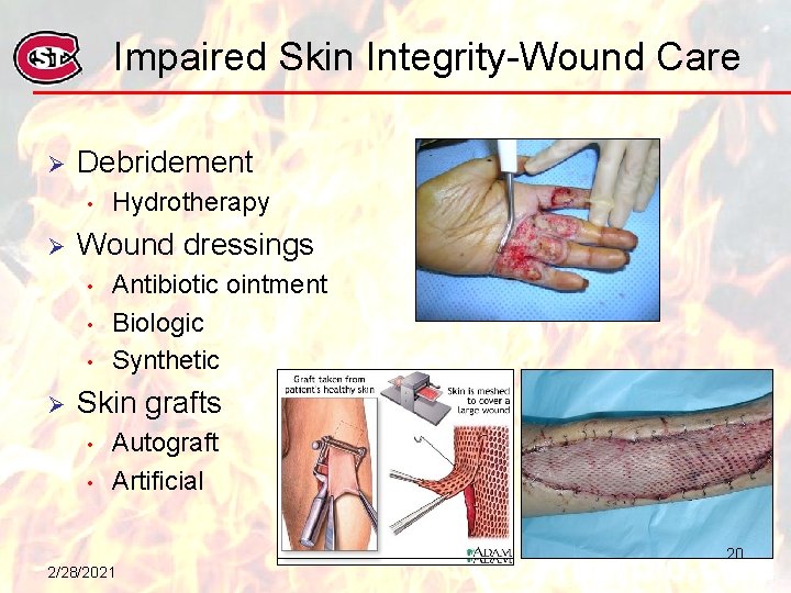 Impaired Skin Integrity-Wound Care Ø Debridement • Ø Wound dressings • • • Ø