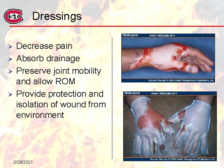 Dressings Ø Ø Decrease pain Absorb drainage Preserve joint mobility and allow ROM Provide
