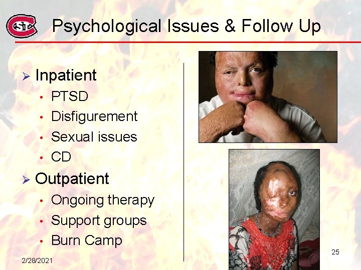 Psychological Issues & Follow Up Ø Inpatient • • Ø PTSD Disfigurement Sexual issues