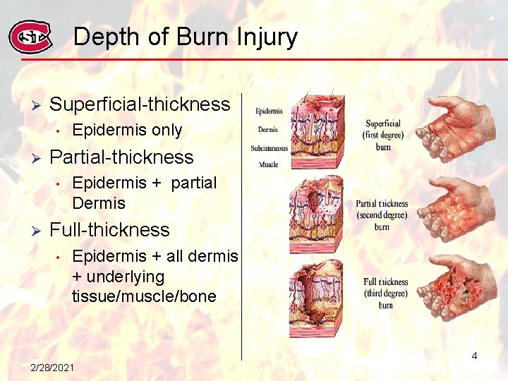 Depth of Burn Injury Ø Superficial-thickness • Ø Partial-thickness • Ø Epidermis only Epidermis