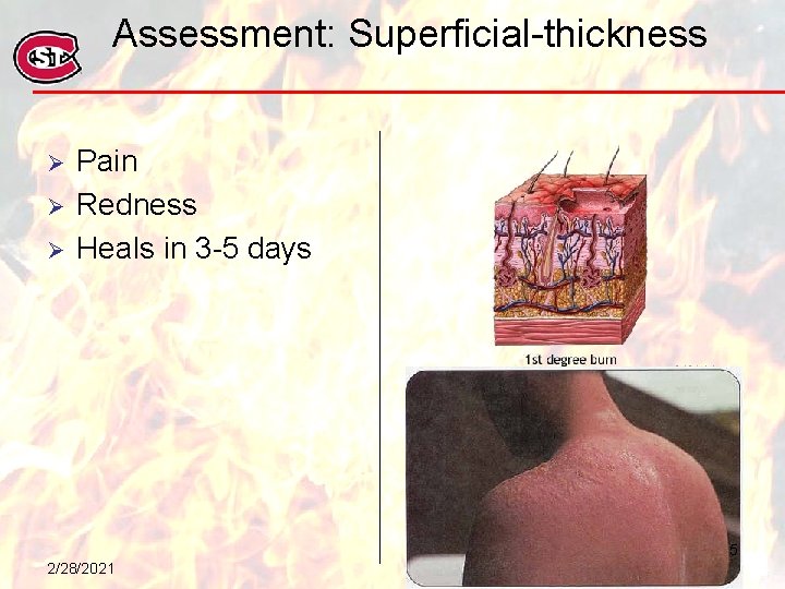 Assessment: Superficial-thickness Ø Ø Ø Pain Redness Heals in 3 -5 days 5 2/28/2021