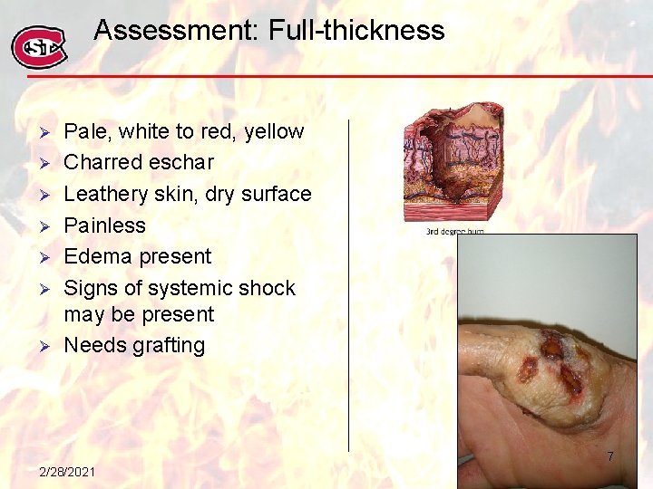 Assessment: Full-thickness Ø Ø Ø Ø Pale, white to red, yellow Charred eschar Leathery