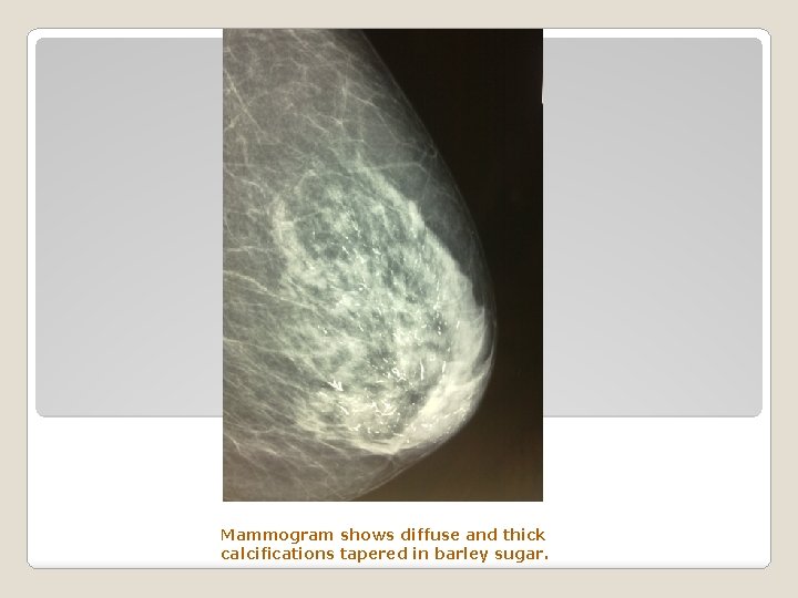 Mammogram shows diffuse and thick calcifications tapered in barley sugar. 