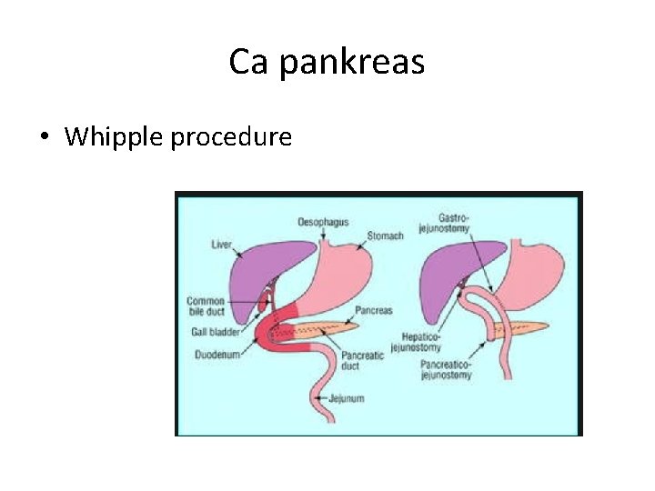 Ca pankreas • Whipple procedure 