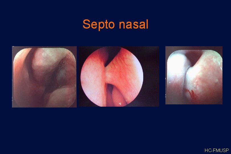 Septo nasal HC-FMUSP 