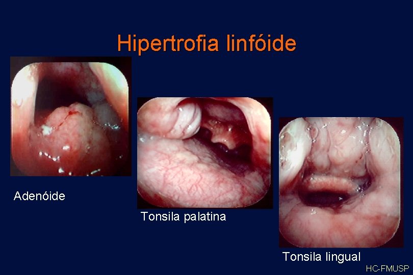 Hipertrofia linfóide Adenóide Tonsila palatina Tonsila lingual HC-FMUSP 