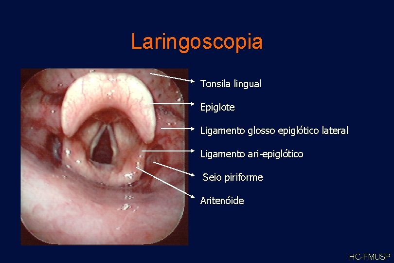 Laringoscopia Tonsila lingual Epiglote Ligamento glosso epiglótico lateral Ligamento ari-epiglótico Seio piriforme Aritenóide HC-FMUSP