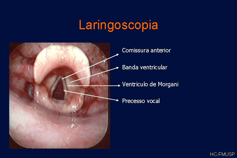 Laringoscopia Comissura anterior Banda ventricular Ventriculo de Morgani Precesso vocal HC-FMUSP 