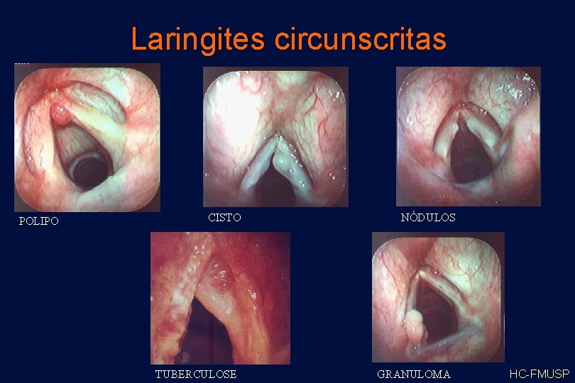 Laringites circunscritas POLIPO CISTO TUBERCULOSE NÓDULOS GRANULOMA HC-FMUSP 