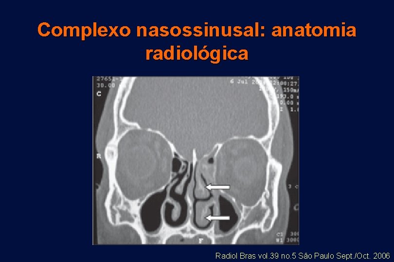 Complexo nasossinusal: anatomia radiológica Radiol Bras vol. 39 no. 5 São Paulo Sept. /Oct.