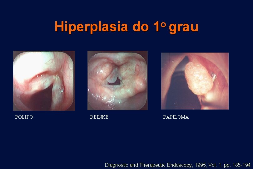 Hiperplasia do POLIPO REINKE o 1 grau PAPILOMA Diagnostic and Therapeutic Endoscopy, 1995, Vol.