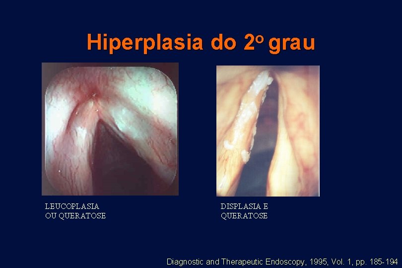 Hiperplasia do LEUCOPLASIA OU QUERATOSE o 2 grau DISPLASIA E QUERATOSE Diagnostic and Therapeutic