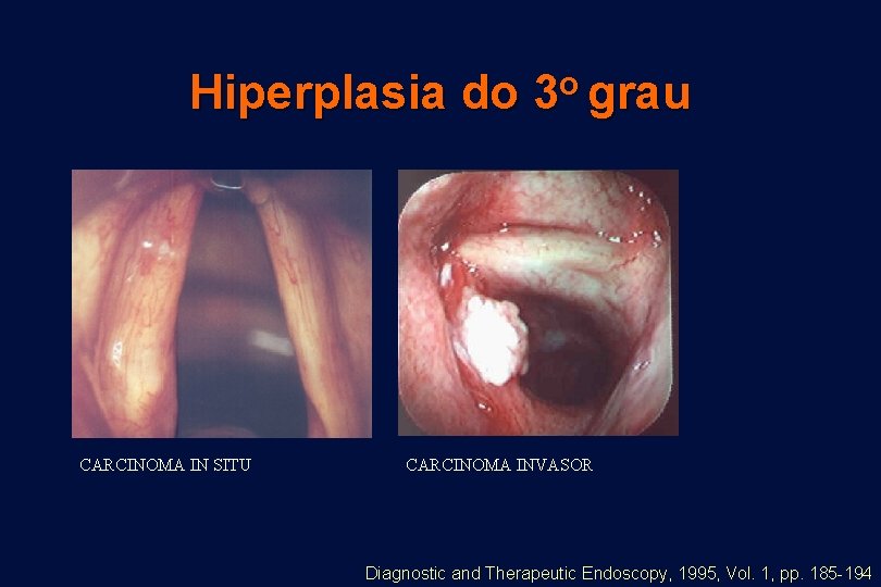 Hiperplasia do CARCINOMA IN SITU o 3 grau CARCINOMA INVASOR Diagnostic and Therapeutic Endoscopy,