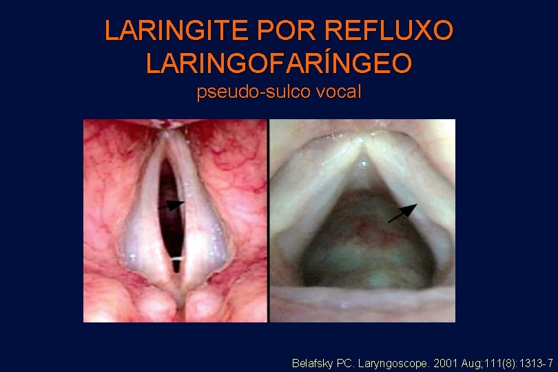 LARINGITE POR REFLUXO LARINGOFARÍNGEO pseudo-sulco vocal Belafsky PC. Laryngoscope. 2001 Aug; 111(8): 1313 -7