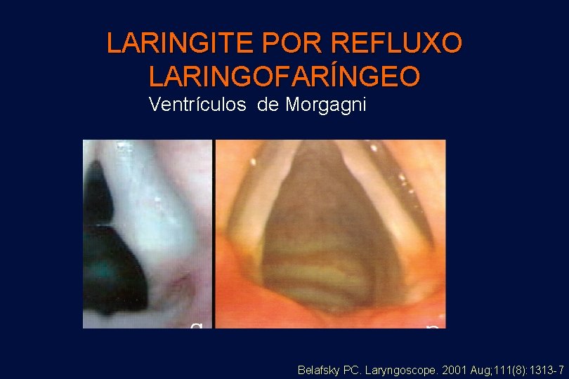 LARINGITE POR REFLUXO LARINGOFARÍNGEO Ventrículos de Morgagni Belafsky PC. Laryngoscope. 2001 Aug; 111(8): 1313