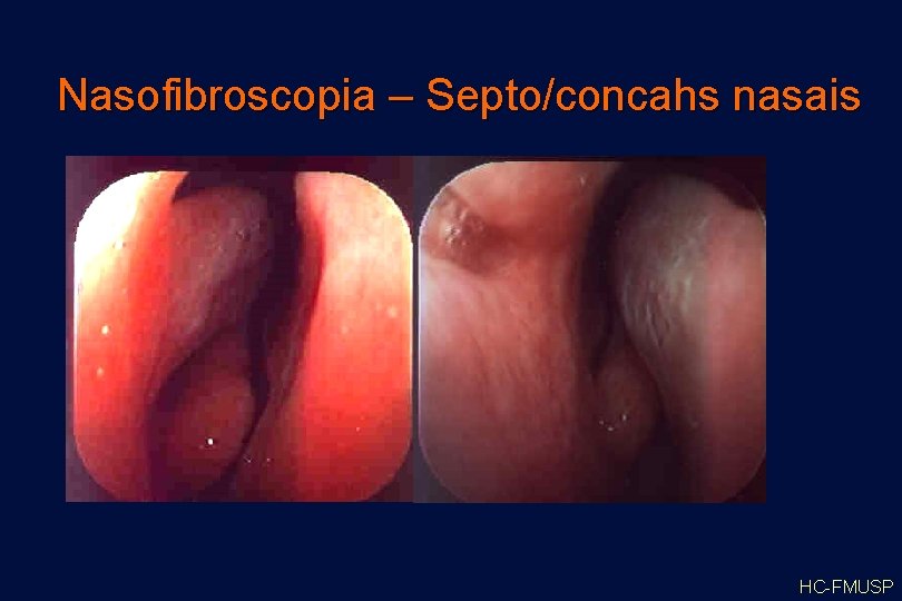 Nasofibroscopia – Septo/concahs nasais HC-FMUSP 