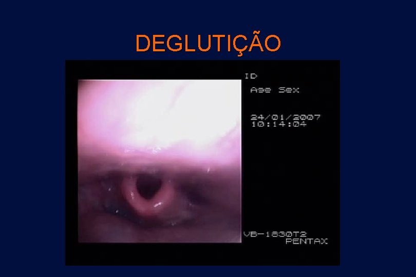 DEGLUTIÇÃO 