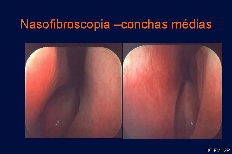 Nasofibroscopia –conchas médias HC-FMUSP 