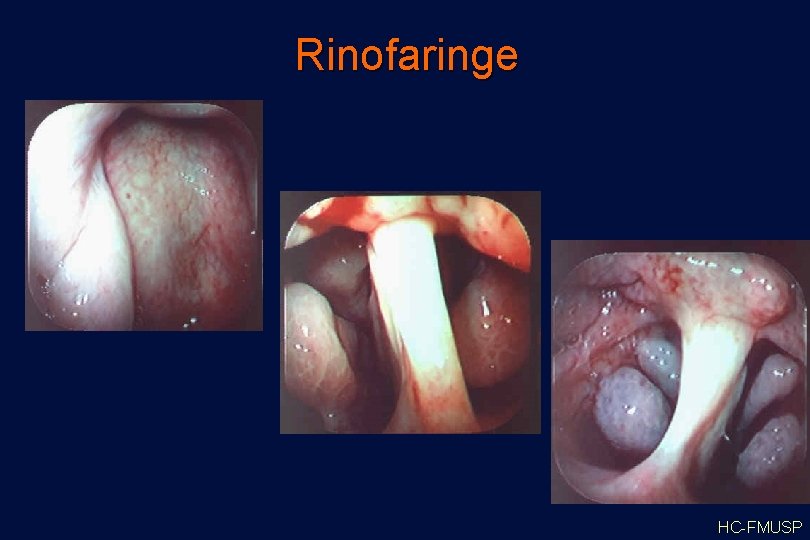 Rinofaringe HC-FMUSP 