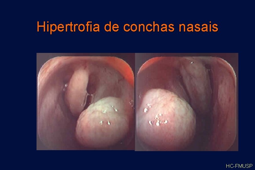 Hipertrofia de conchas nasais HC-FMUSP 