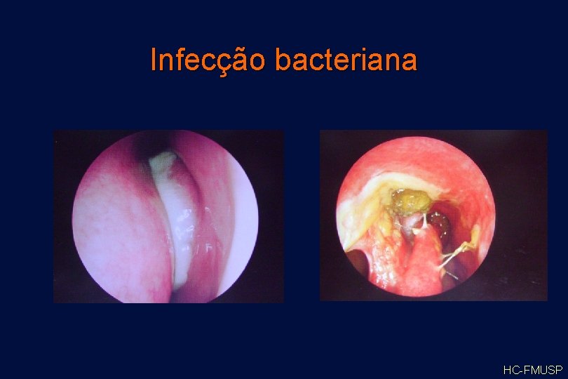 Infecção bacteriana HC-FMUSP 