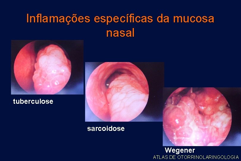 Inflamações específicas da mucosa nasal tuberculose sarcoidose Wegener ATLAS DE OTORRINOLARINGOLOGIA 