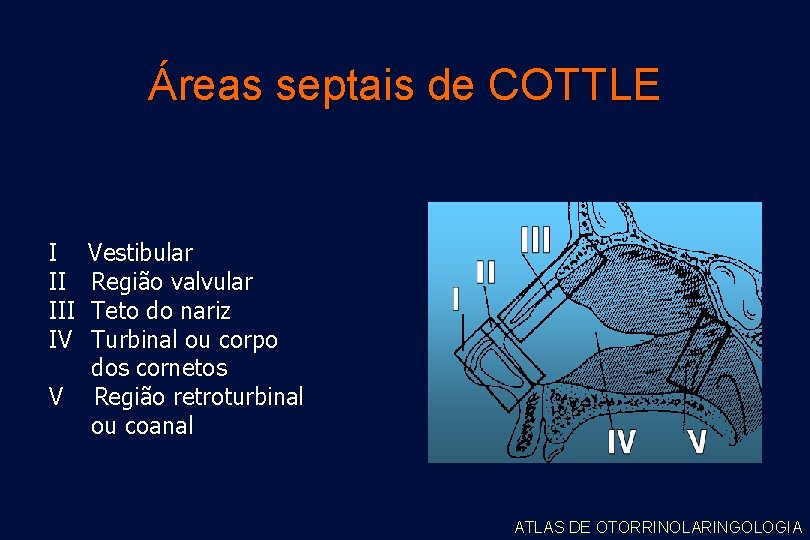 Áreas septais de COTTLE I II IV Vestibular Região valvular Teto do nariz Turbinal