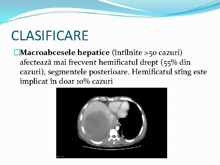 CLASIFICARE �Macroabcesele hepatice (întîlnite >50 cazuri) afectează mai frecvent hemificatul drept (55% din cazuri),