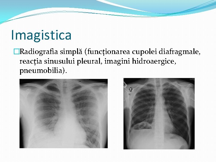 Imagistica �Radiografia simplă (funcţionarea cupolei diafragmale, reacţia sinusului pleural, imagini hidroaergice, pneumobilia). 
