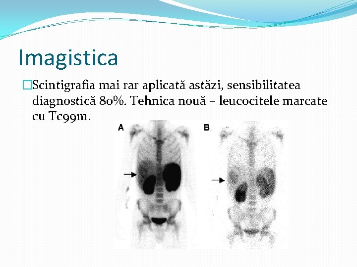 Imagistica �Scintigrafia mai rar aplicată astăzi, sensibilitatea diagnostică 80%. Tehnica nouă – leucocitele marcate