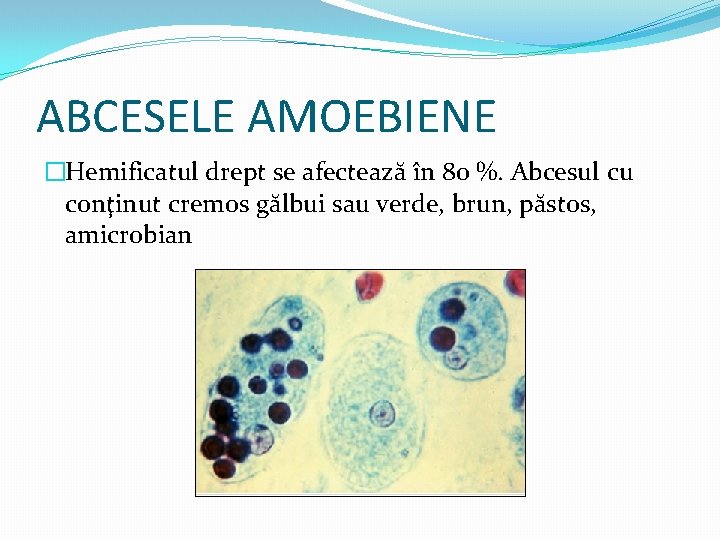 ABCESELE AMOEBIENE �Hemificatul drept se afectează în 80 %. Abcesul cu conţinut cremos gălbui