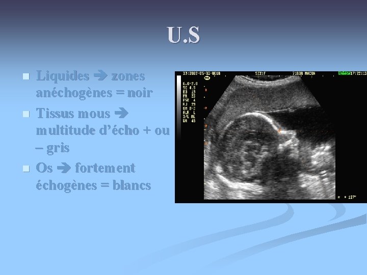 U. S n n n Liquides zones anéchogènes = noir Tissus mous multitude d’écho U. S n n n Liquides zones anéchogènes = noir Tissus mous multitude d’écho