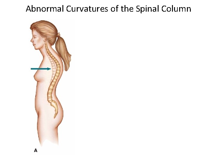 Abnormal Curvatures of the Spinal Column 