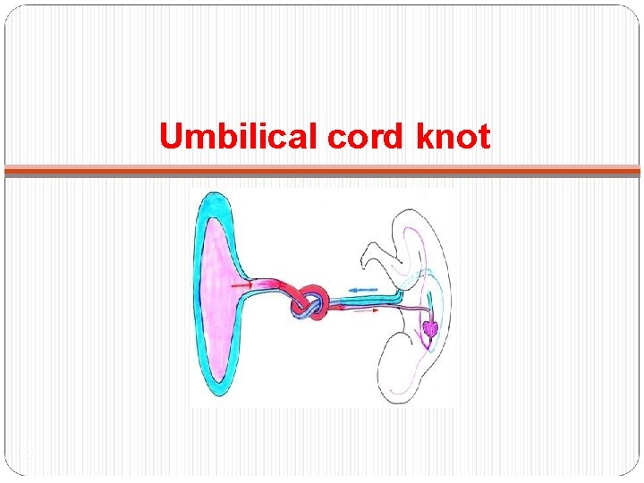 Umbilical cord knot 12 