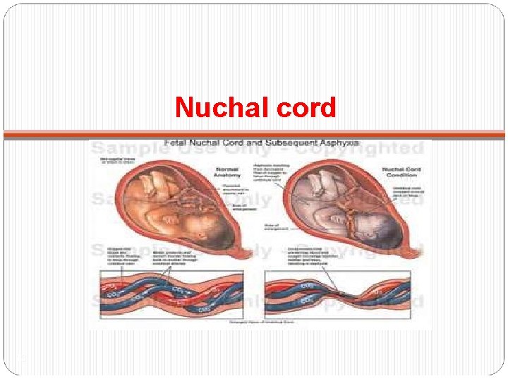 Nuchal cord 13 