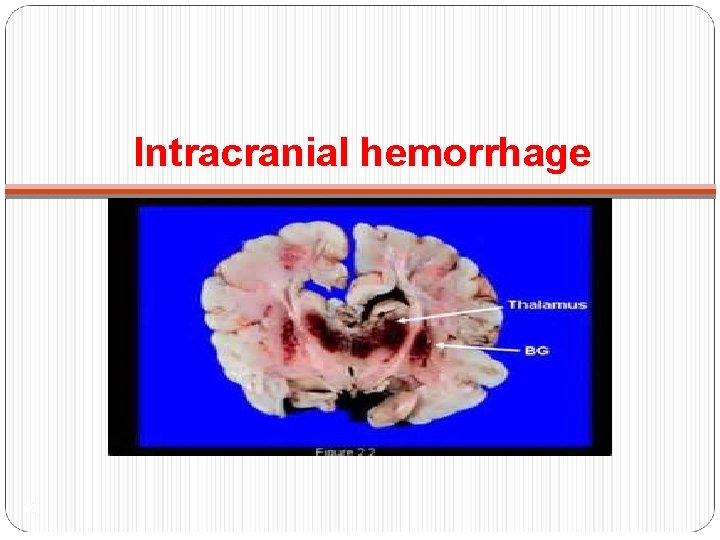 Intracranial hemorrhage 18 