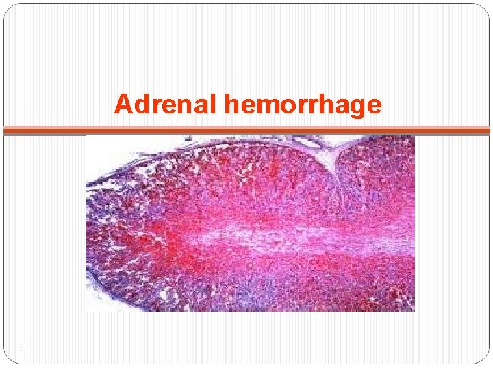 Adrenal hemorrhage 20 