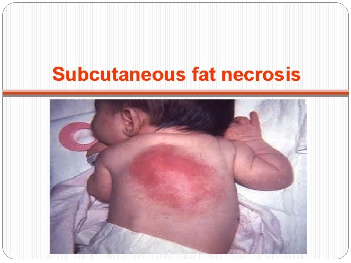 Subcutaneous fat necrosis 21 