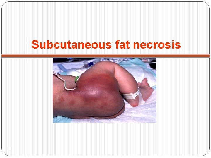 Subcutaneous fat necrosis 23 