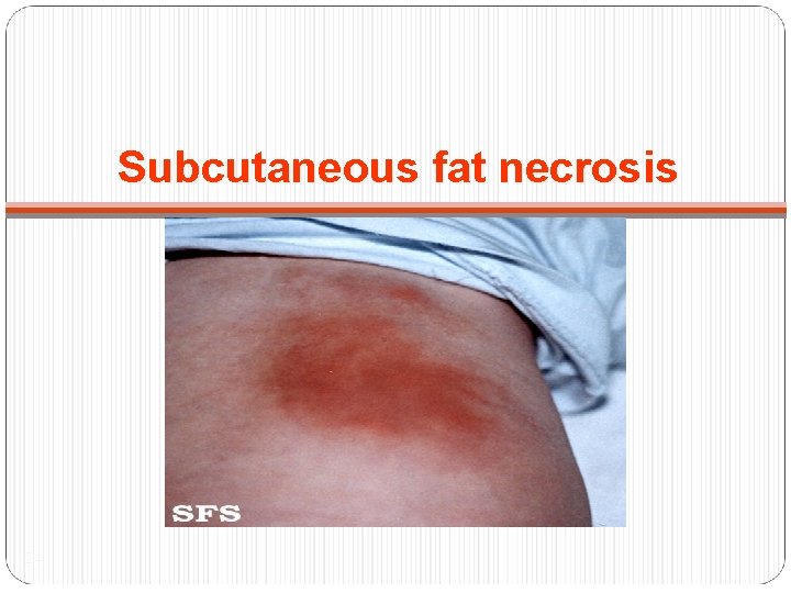 Subcutaneous fat necrosis 24 